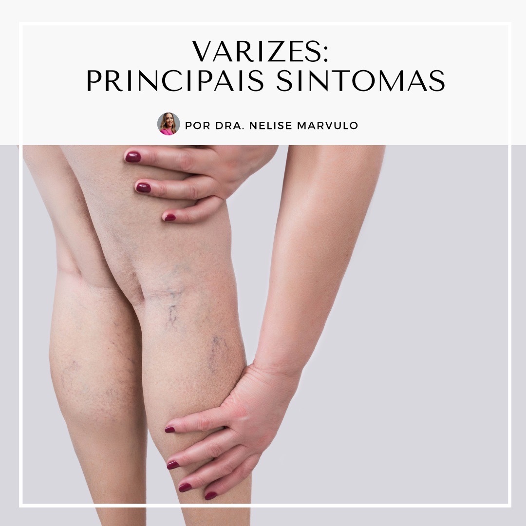 Principais sintomas de Varizes